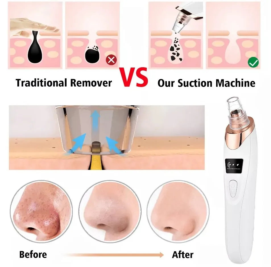 5-in-1 Blackhead Remover Machine | Rechargeable Facial Pore Vacuum